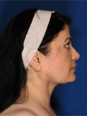 Patient # 66616 After Photo # 2